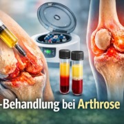 PRP-Behandlung bei Arthrose: Injektion von plättchenreichem Eigenblut in ein entzündetes Kniegelenk zur biologischen Therapie