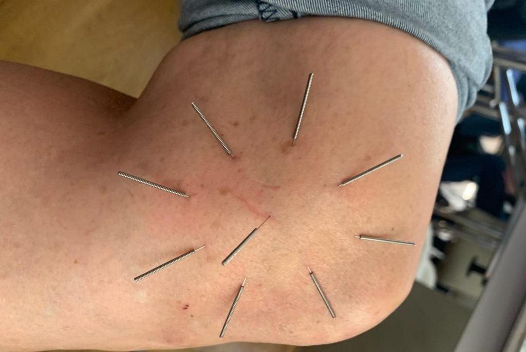 Akpunktur eines Patienten am Knie. Hier eine Sternakupunktur nach Boel.