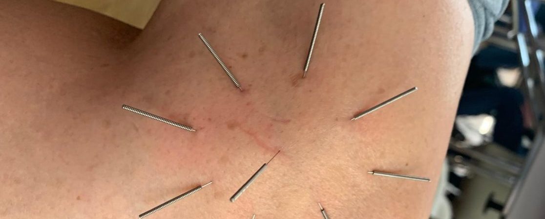 Akpunktur eines Patienten am Knie. Hier eine Sternakupunktur nach Boel.