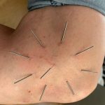 Akpunktur eines Patienten am Knie. Hier eine Sternakupunktur nach Boel.