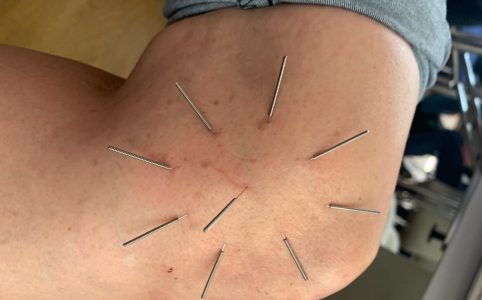 Akpunktur eines Patienten am Knie. Hier eine Sternakupunktur nach Boel.