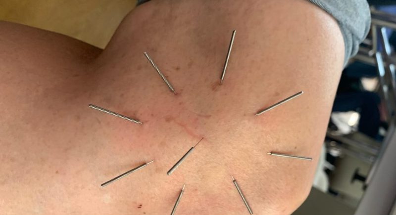 Akpunktur eines Patienten am Knie. Hier eine Sternakupunktur nach Boel.