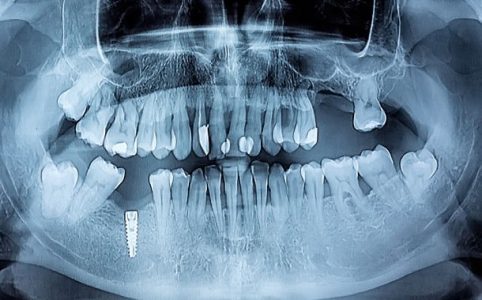 Panorama Röntgen Zähne / Gebiss
