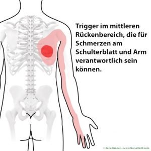 Chronische Schmerzen durch Myofasziale Triggerpunkte?