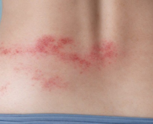 Zosterausschlag im unteren Rückenbereich