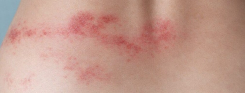 Zosterausschlag im unteren Rückenbereich