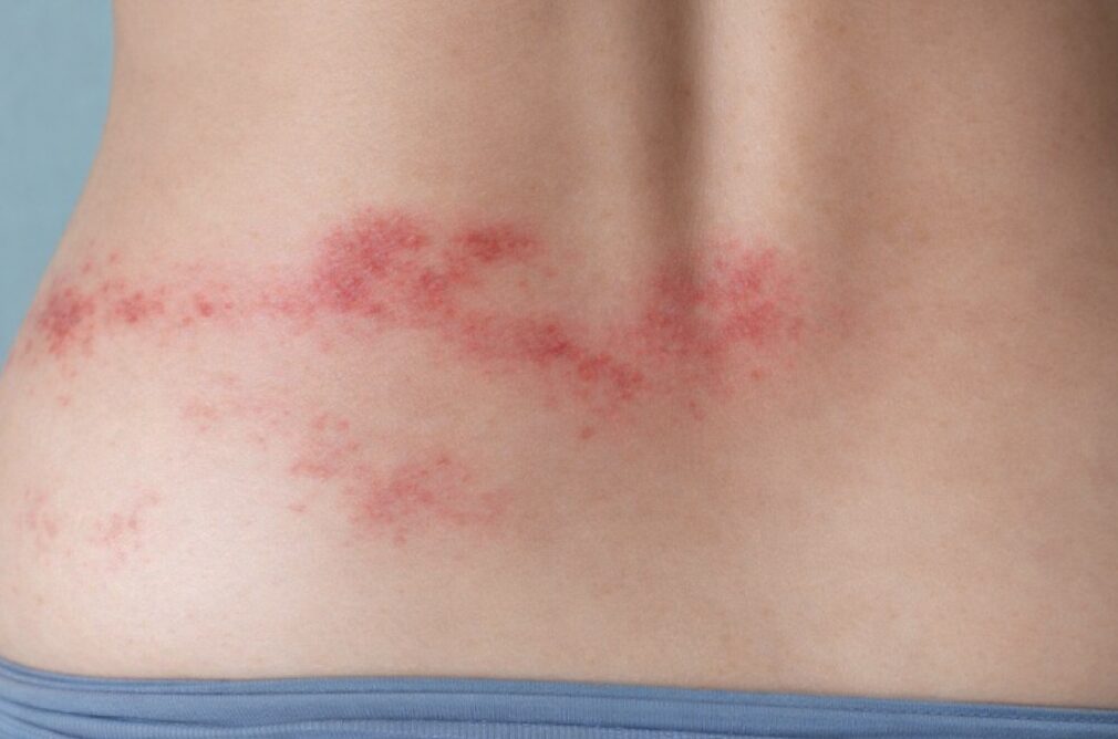 Zosterausschlag im unteren Rückenbereich