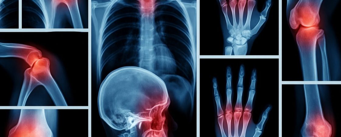 Digitale Collage aus Röntgenbildern mit rot hervorgehobenen Gelenken – symbolisiert Osteoporose, Knochenschmerzen und entzündliche Prozesse im Bewegungsapparat.