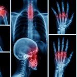 Digitale Collage aus Röntgenbildern mit rot hervorgehobenen Gelenken – symbolisiert Osteoporose, Knochenschmerzen und entzündliche Prozesse im Bewegungsapparat.