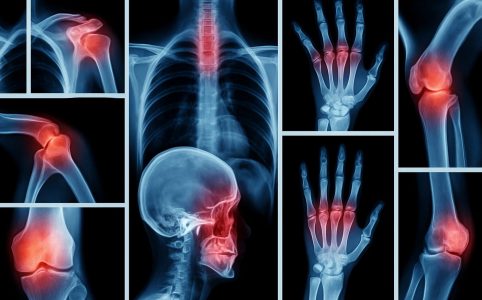 Digitale Collage aus Röntgenbildern mit rot hervorgehobenen Gelenken – symbolisiert Osteoporose, Knochenschmerzen und entzündliche Prozesse im Bewegungsapparat.