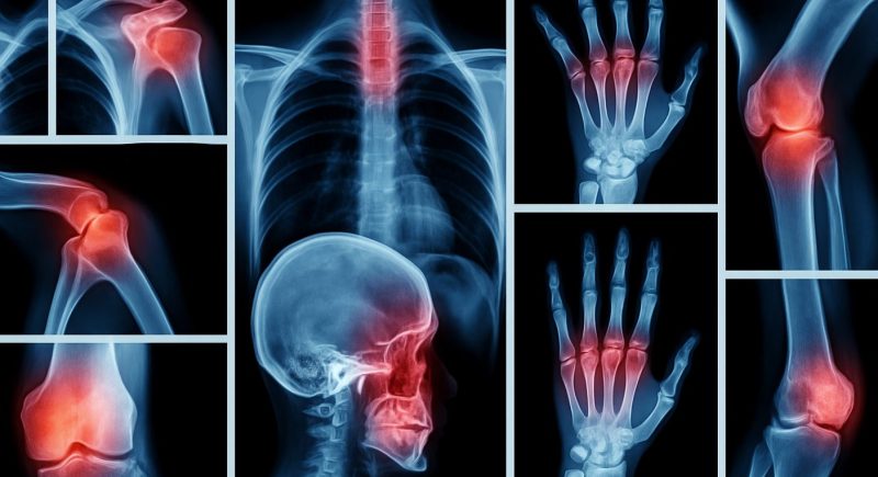 Digitale Collage aus Röntgenbildern mit rot hervorgehobenen Gelenken – symbolisiert Osteoporose, Knochenschmerzen und entzündliche Prozesse im Bewegungsapparat.
