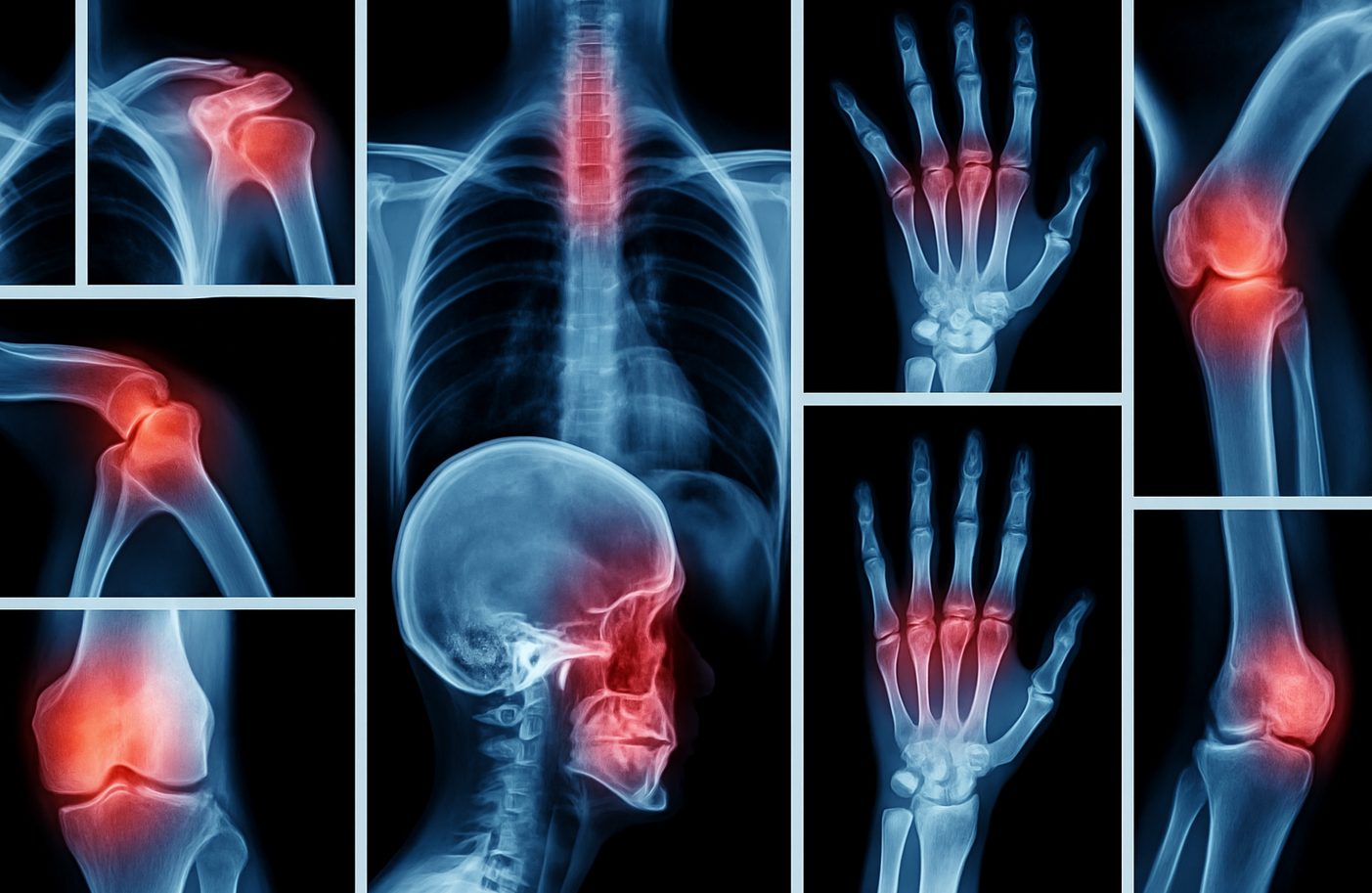 Digitale Collage aus Röntgenbildern mit rot hervorgehobenen Gelenken – symbolisiert Osteoporose, Knochenschmerzen und entzündliche Prozesse im Bewegungsapparat.
