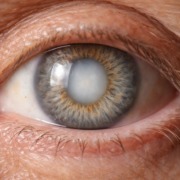 katarakt-grauer-star Nahaufnahme eines menschlichen Auges mit grauem Star (Katarakt), deutlich sichtbare Linsentrübung im Zentrum der Pupille.