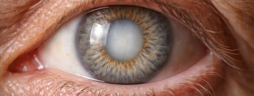 Nahaufnahme eines menschlichen Auges mit grauem Star (Katarakt), deutlich sichtbare Linsentrübung im Zentrum der Pupille.